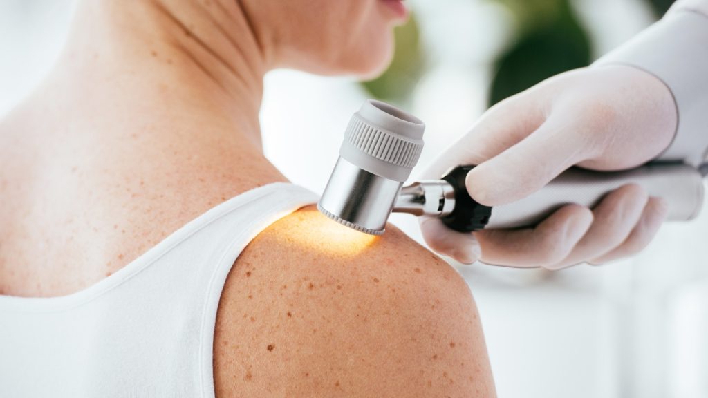 melanoma, anyajegy vizsgálat, bőrrák