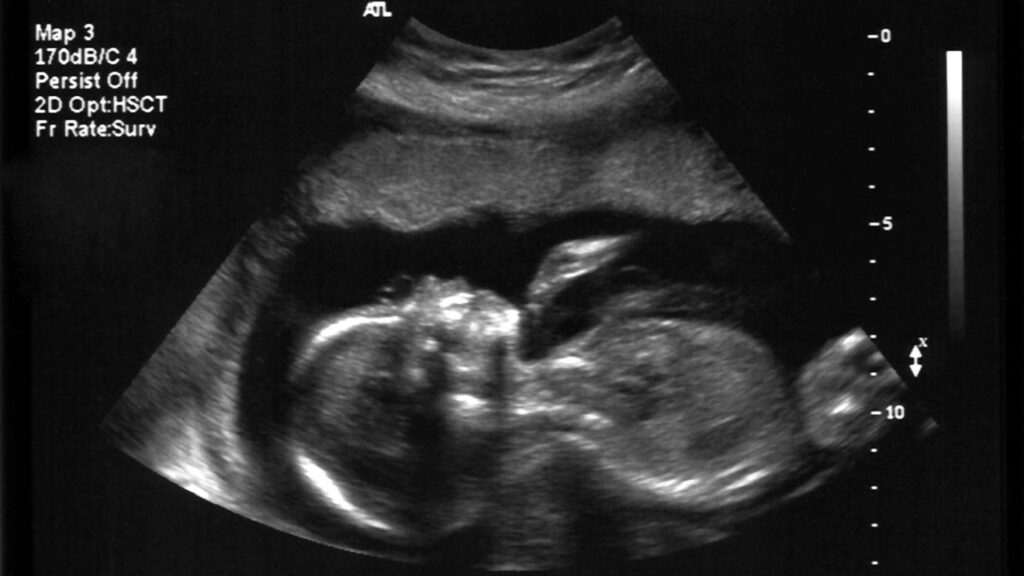 szívhangrendelet, abortusz, magzat
