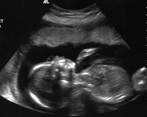 szívhangrendelet, abortusz, magzat