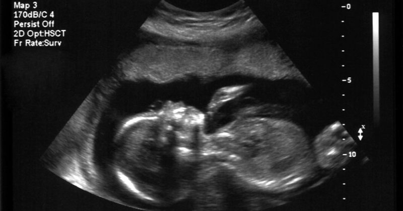 szívhangrendelet, abortusz, magzat