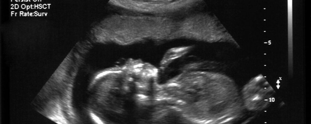 szívhangrendelet, abortusz, magzat