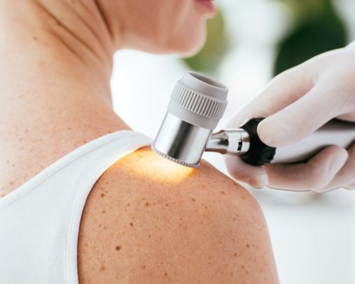 melanoma, anyajegy vizsgálat, bőrrák
