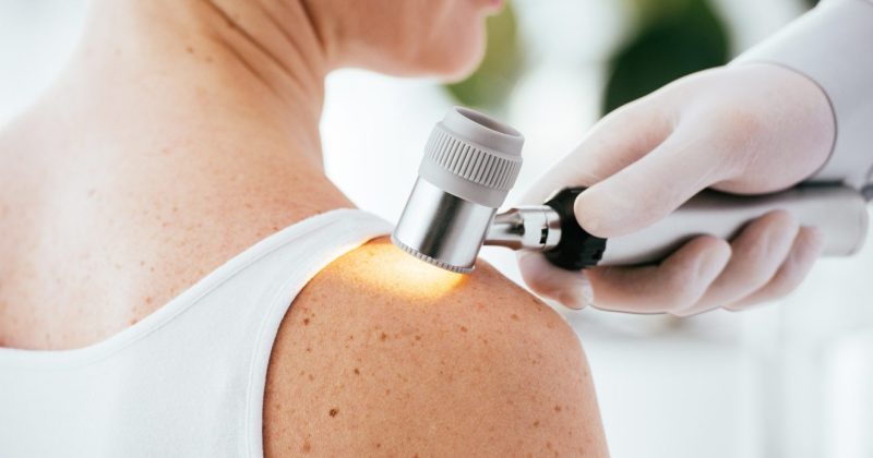 melanoma, anyajegy vizsgálat, bőrrák